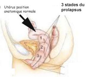 Les 3 stades du prolapsus utérin
